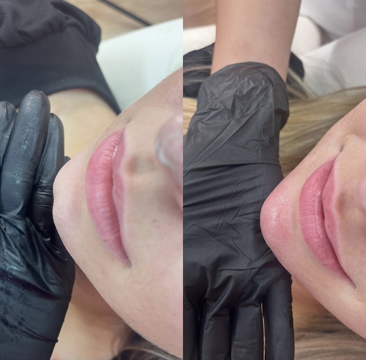 Chin enhancement result